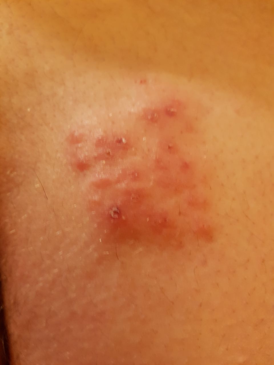 Was könnte das für ein ausschlag sein an rechter po backe? (Gesundheit